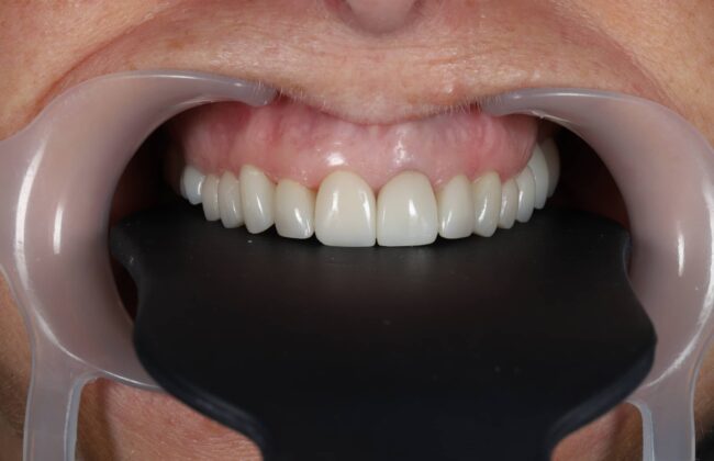 After (Teeth)