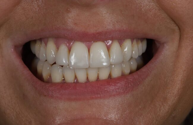 After (Teeth)