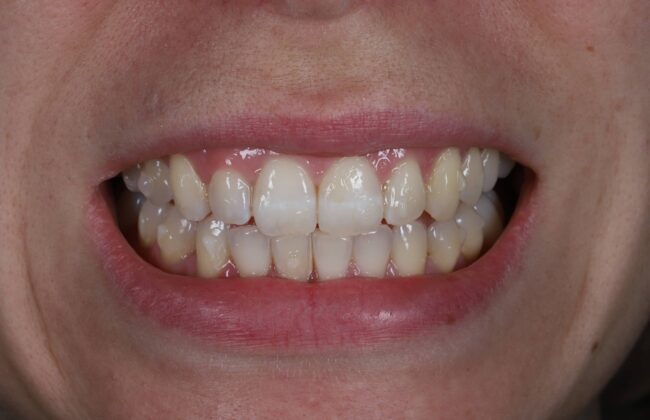 After (Teeth)