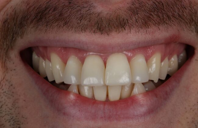 After (Teeth)