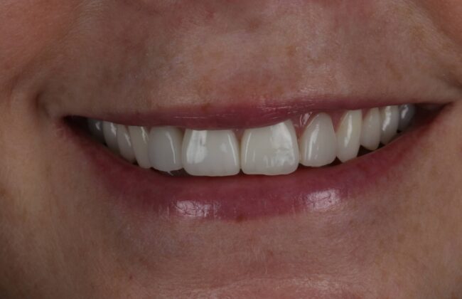After (Teeth)