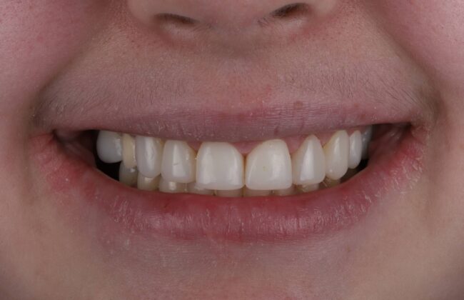 After (Teeth)
