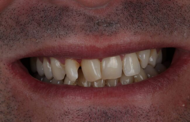Before (Teeth)