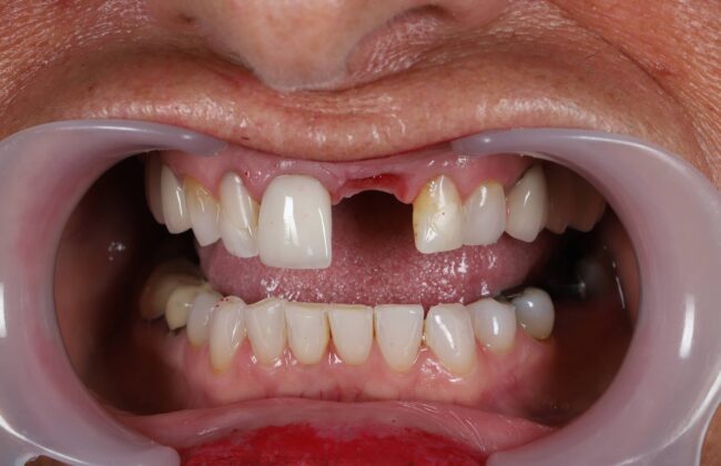 Before (Teeth)