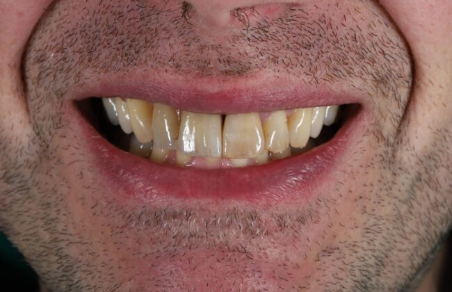 After (Teeth)