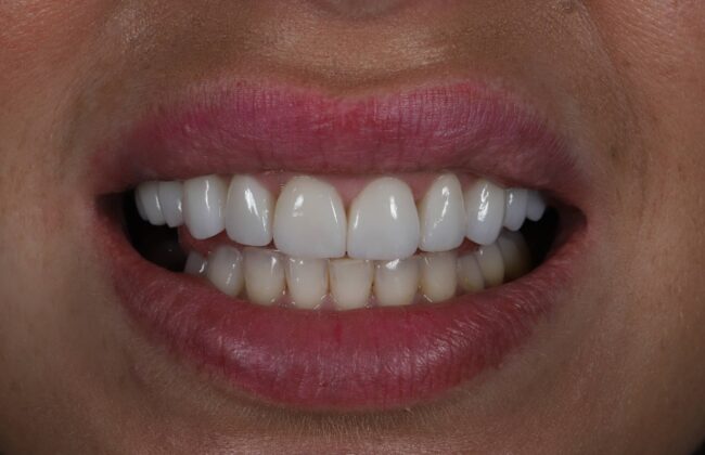 After (Teeth)