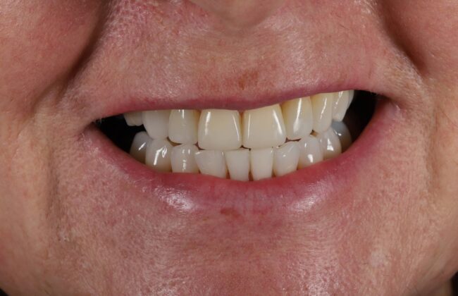 After (Teeth)