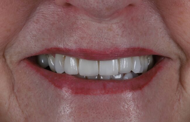After (Teeth)