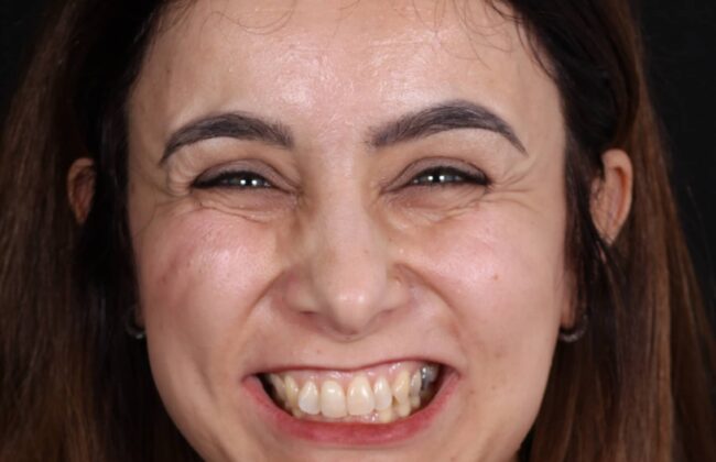 Before (Teeth)