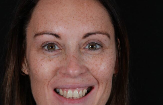 Before (Teeth)