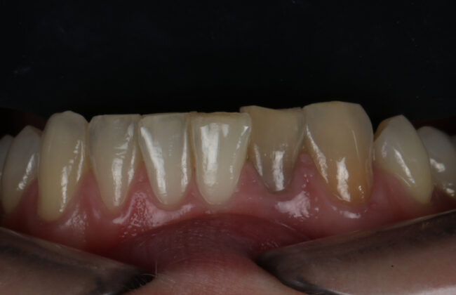 Before (Teeth)