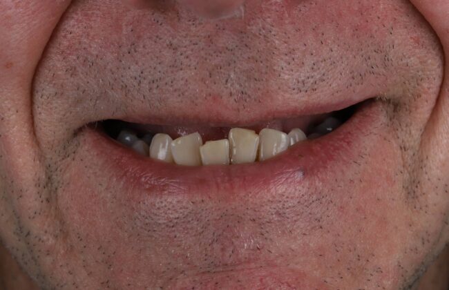 Before (Teeth)