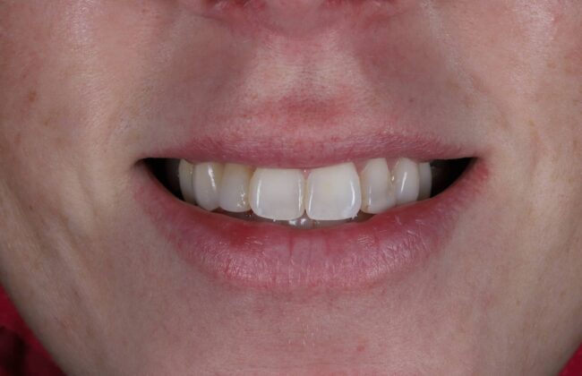 Before (Teeth)