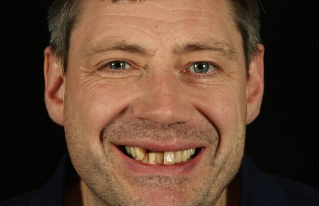 Before (Teeth)