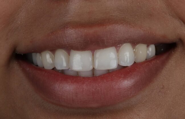 After (Teeth)