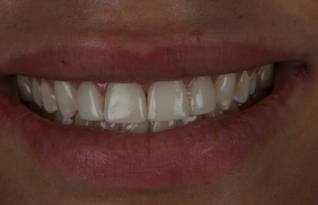 After (Teeth)