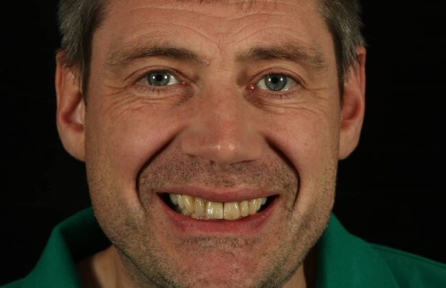 After (Teeth)