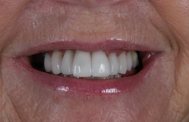 After (Teeth)