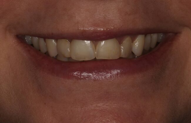 Before (Teeth)