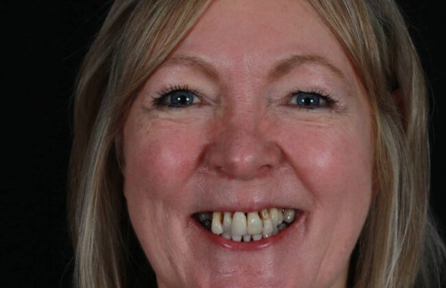 Before (Teeth)