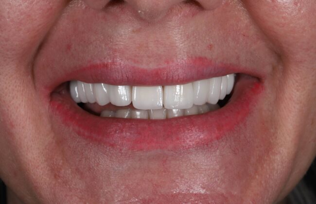 After (Teeth)