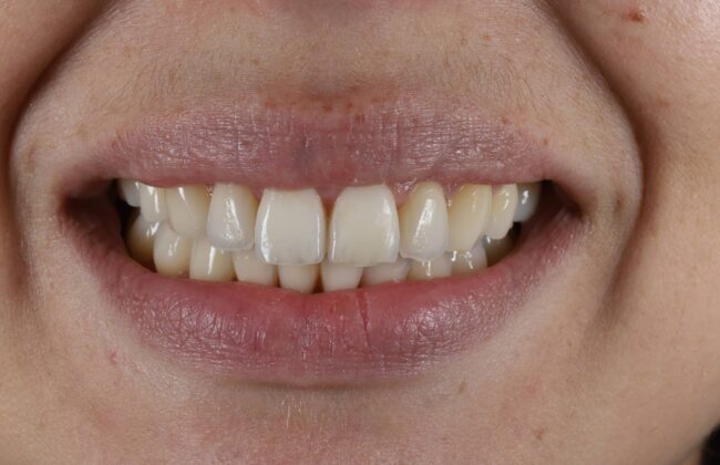 After (Teeth)