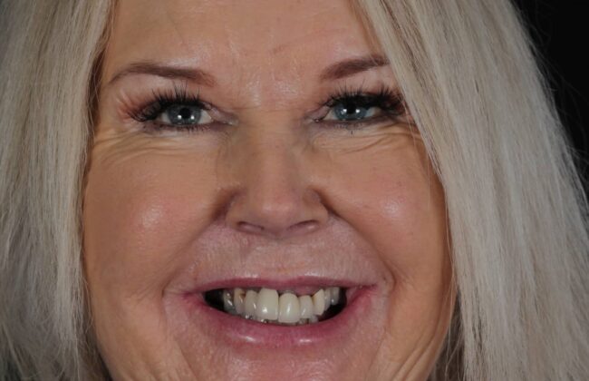 Before (Teeth)