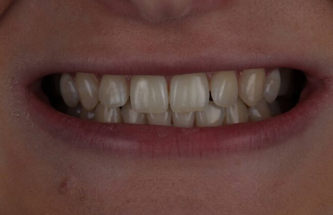 Before (Teeth)
