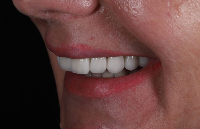 After (Teeth)