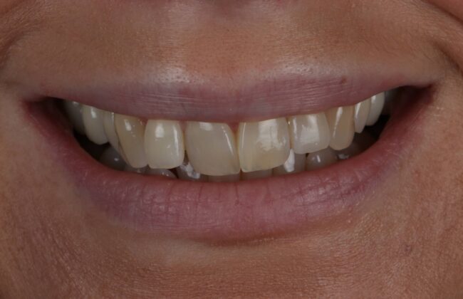 Before (Teeth)