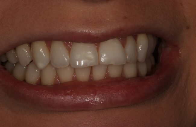 Before (Teeth)