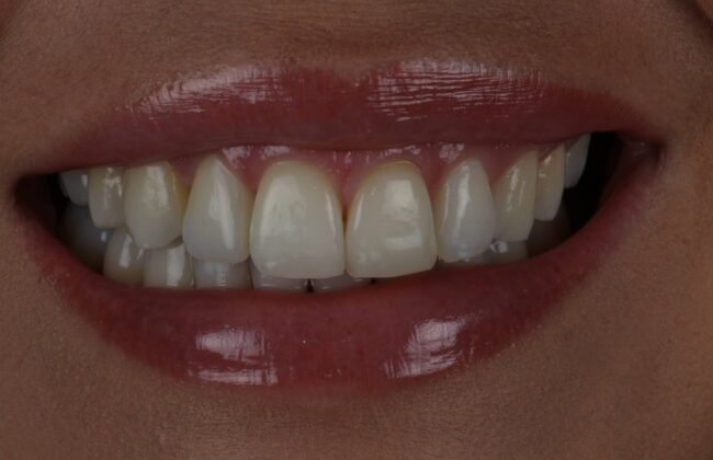 After (Teeth)