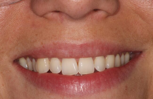 Before (Teeth)