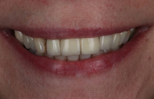 Before (Teeth)