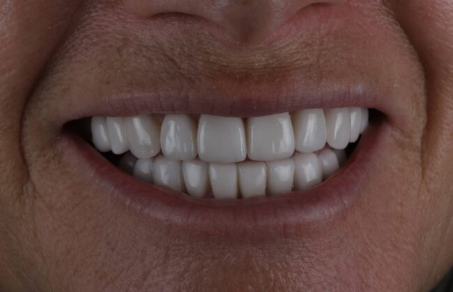 After (Teeth)