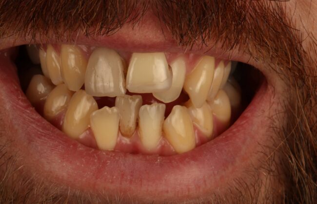 Before (Teeth)