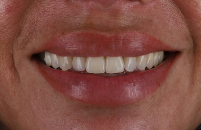 After (Teeth)