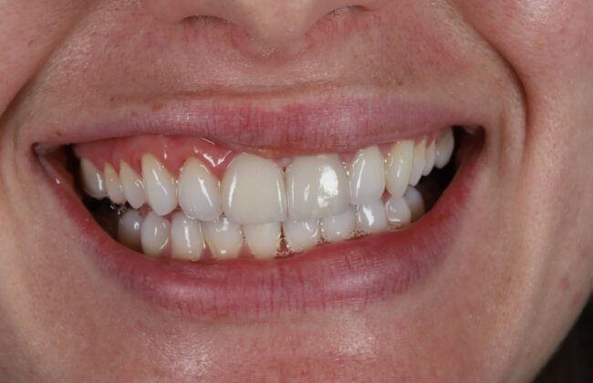 After (Teeth)