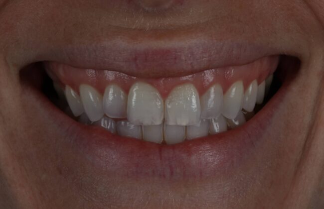 Before (Teeth)
