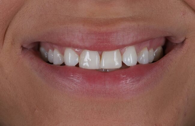 Before (Teeth)
