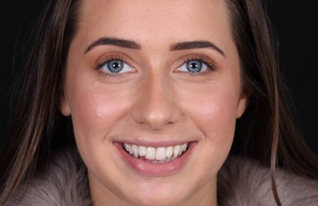 Before (Teeth)
