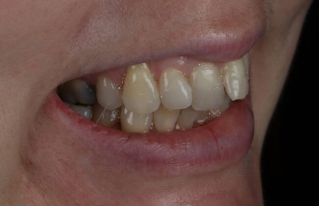 Before (Teeth)