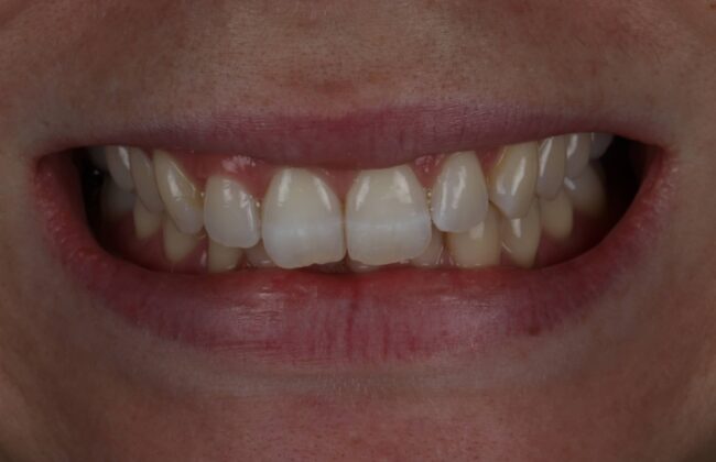 Before (Teeth)