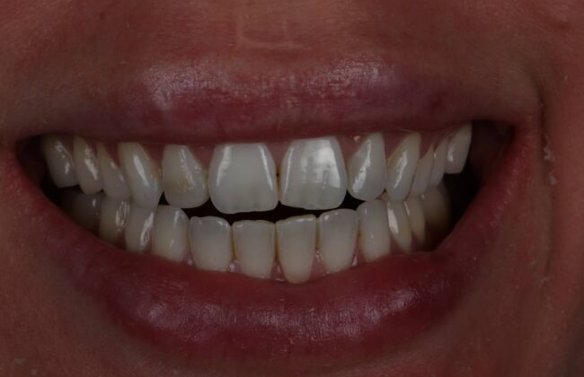 Before (Teeth)