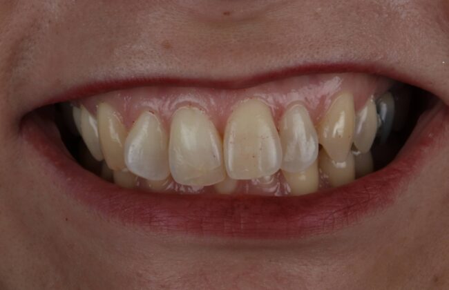 Before (Teeth)