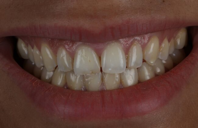 Before (Teeth)