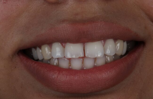 Before (Teeth)