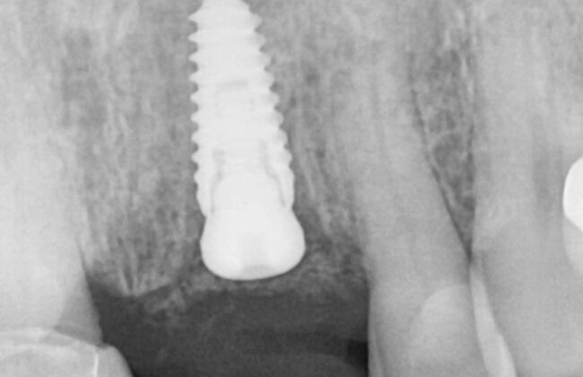 Before (Teeth)