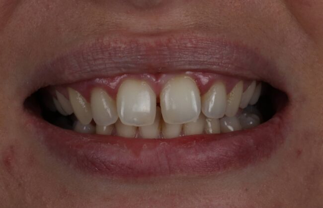 Before (Teeth)