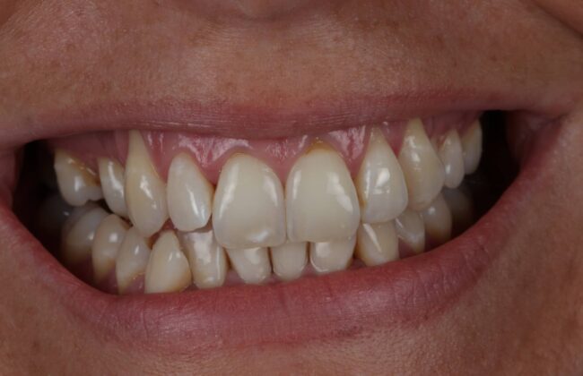 Before (Teeth)
